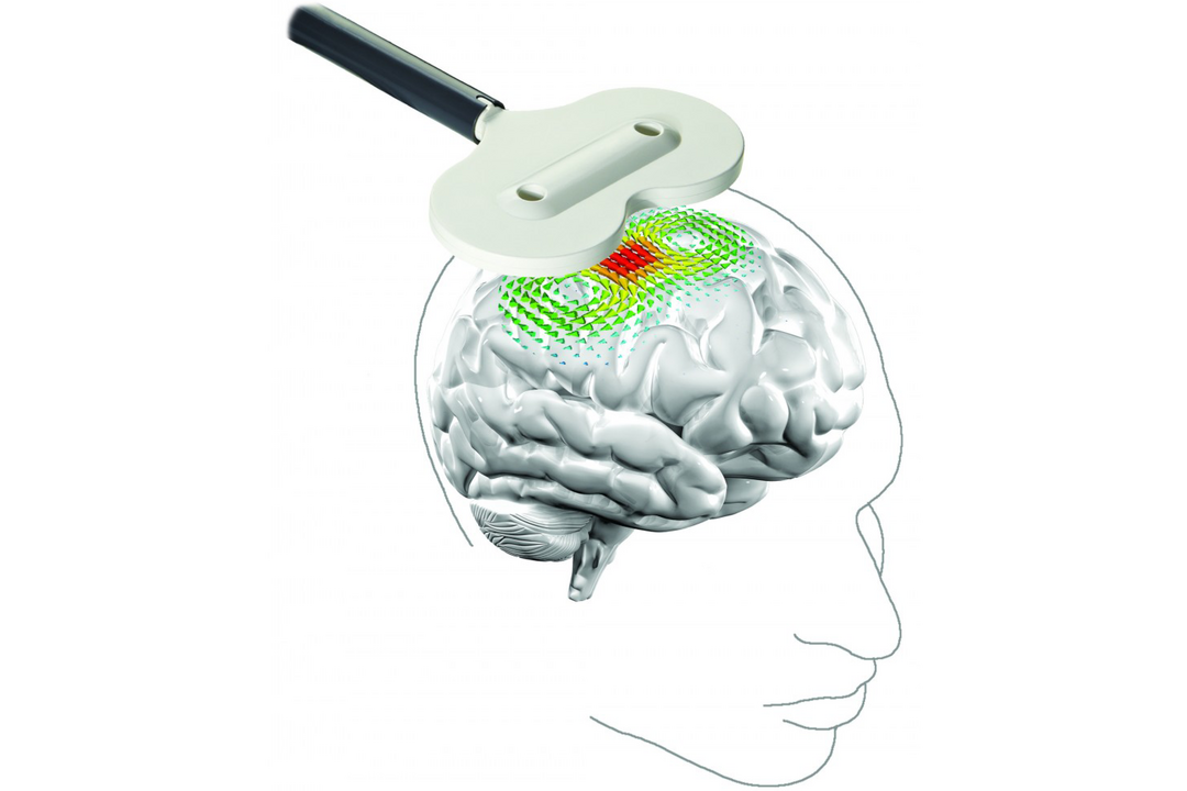 Die repetetive transkranielle Magnetstimulation